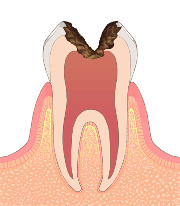 虫歯 レベル３（c3） 画像